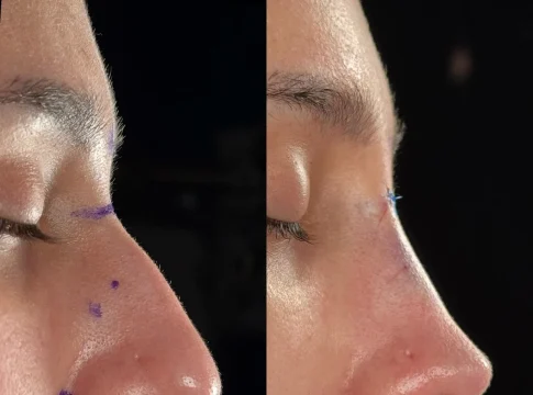 Rinoplastía Rinoplastía