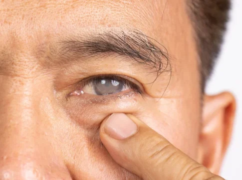 Cataratas y protección solar Prevención de cataratas solares