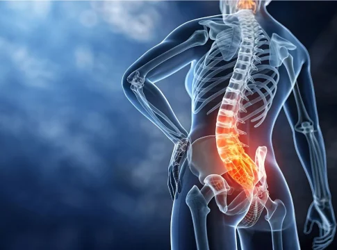 ciatico Dolor ciático