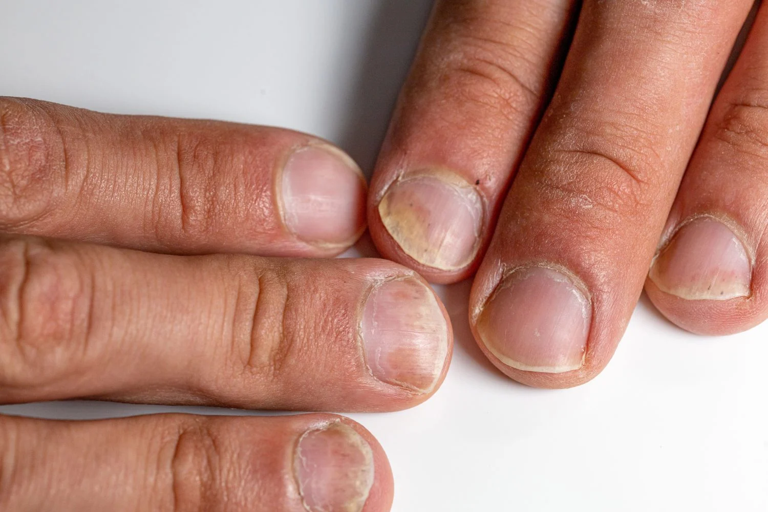 Al igual que con los lunares, los dermatólogos han desarrollado una guía para identificar las señales de alarma. Fuente: Freepik
