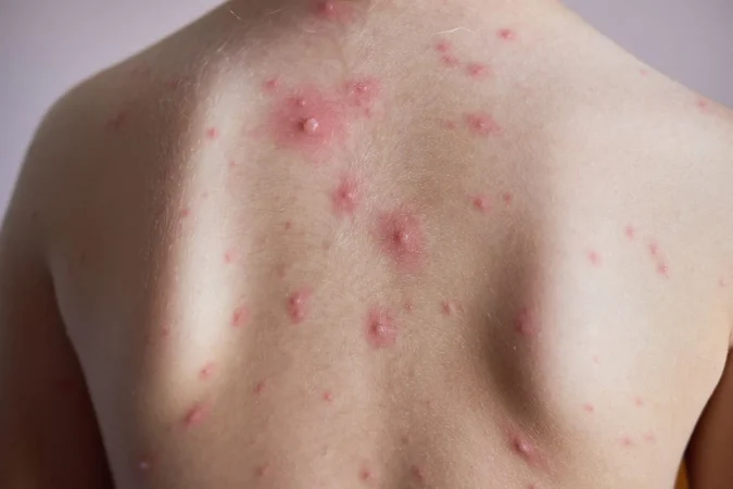 La rutina perfecta para adolescentes con acné: solo necesitas estos 2 productos básicos 3 Merca2.es 098 acne87 Merca2.es