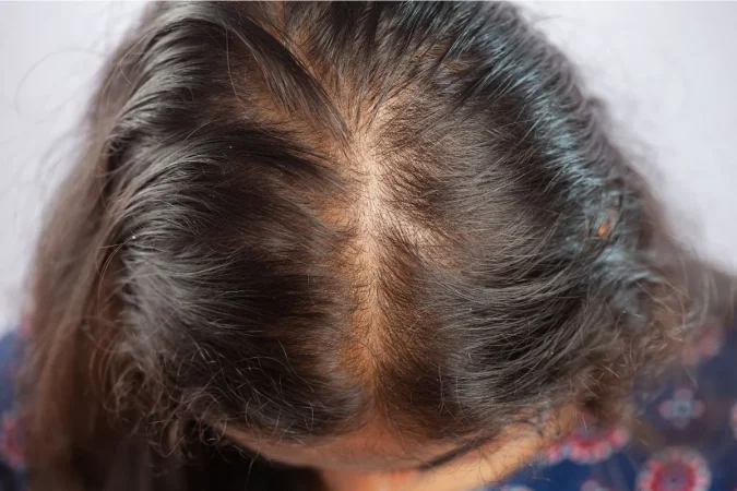 No es genética: el estrés es la verdadera chispa que acelera tu alopecia 3 Merca2.es alopecia643w Merca2.es