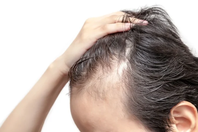 No es genética: el estrés es la verdadera chispa que acelera tu alopecia 1 Merca2.es alopecia