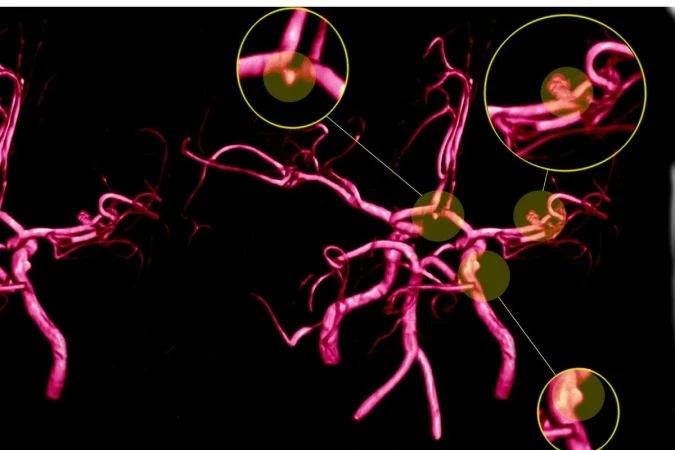 Dr. Rodolfo Alcedo, neurocirujano endovascular: "Una de cada 50 personas camina por ahí con un aneurisma sin saberlo" 1 Merca2.es aneurisma