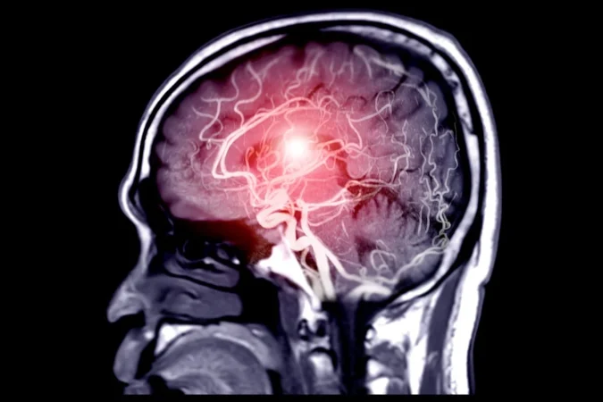 Dr. Rodolfo Alcedo, neurocirujano endovascular: "Una de cada 50 personas camina por ahí con un aneurisma sin saberlo" 2 Merca2.es aneurisma 7p Merca2.es
