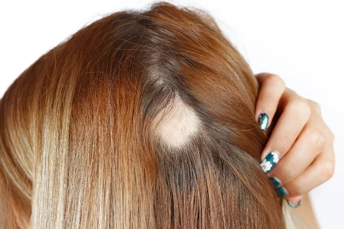 De peor a mejor: el ranking real de los tratamientos tópicos contra la alopecia que recomiendan los expertos 1 Merca2.es alopecia
