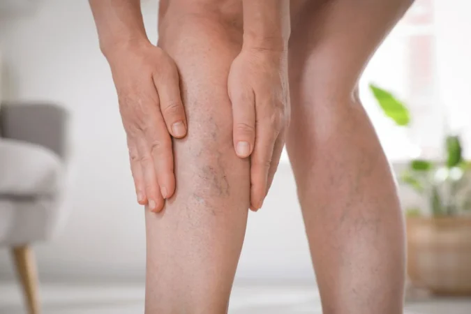 tratar la trombosis1 Merca2.es