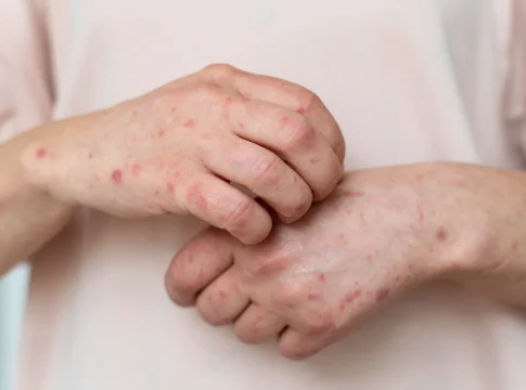 Sanidad alerta, el sarampión podría regresar a España y la culpa es tuya Sanidad alerta, el sarampión podría regresar a España y la culpa es tuya