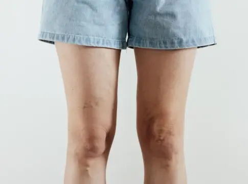 piernas hinchadas. Quironsalud piernas hinchadas y varices