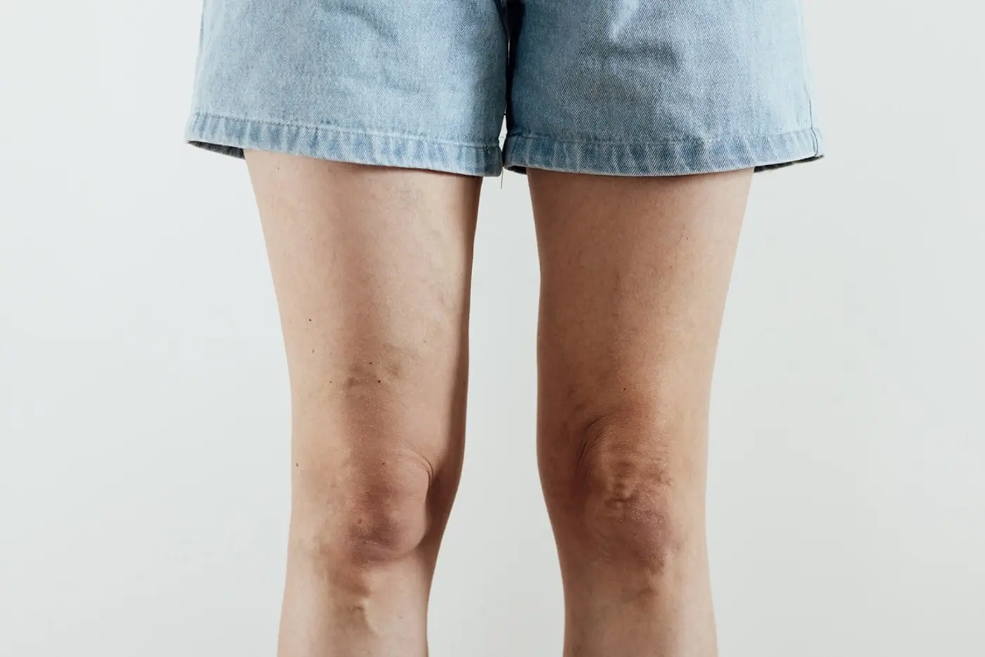 piernas hinchadas. Quironsalud piernas hinchadas y varices