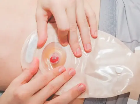 ostomía ostomía